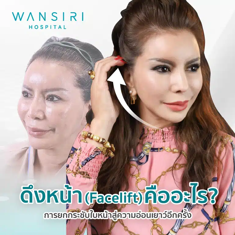 การดึงหน้า (Facelift) คืออะไร?