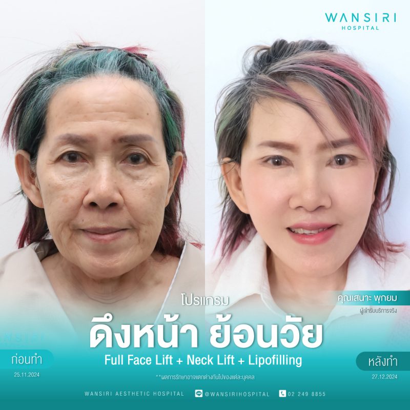 รีวิว ดึงหน้า ย้อนวัย