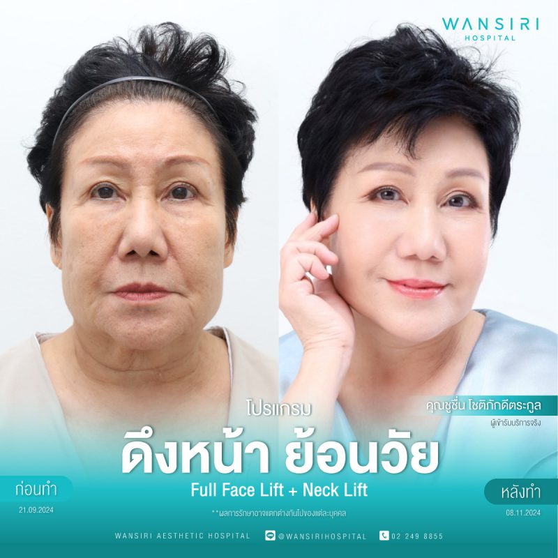 รีวิว ดึงหน้า ย้อนวัย