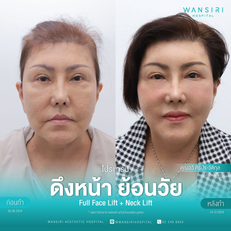 รีวิว ดึงหน้า ย้อนวัย