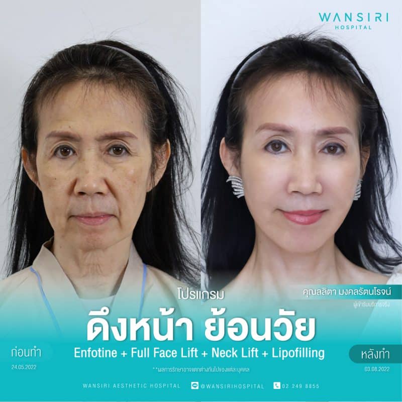 รีวิว ดึงหน้า ย้อนวัย