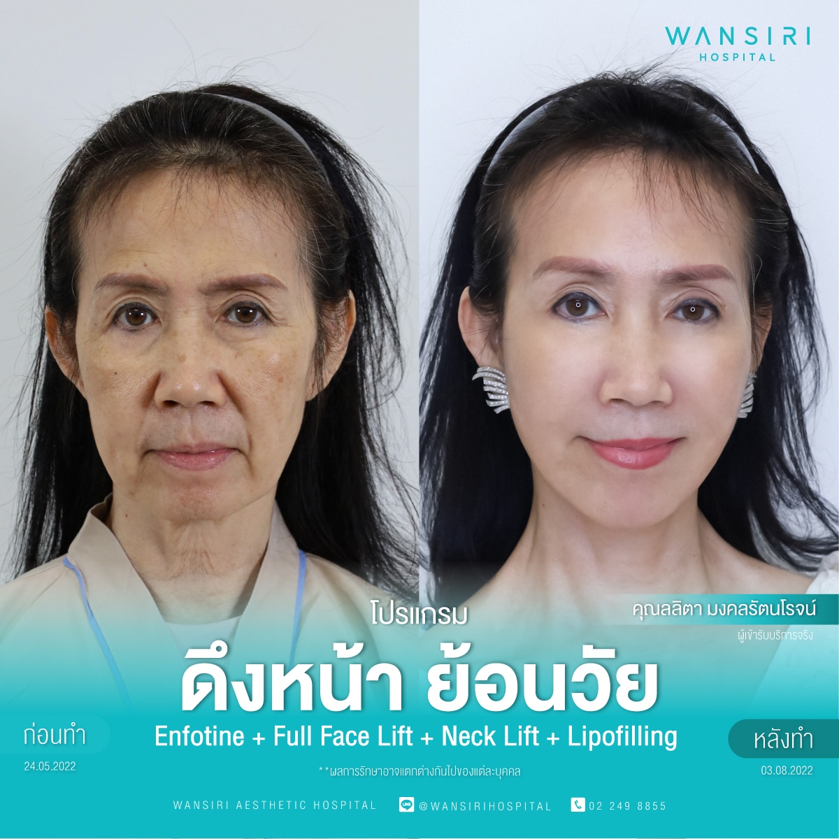 รีวิว ดึงหน้า ย้อนวัย