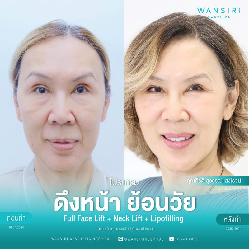 รีวิว ดึงหน้า ย้อนวัย