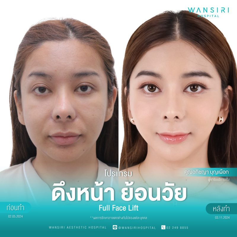 รีวิว ดึงหน้า ย้อนวัย