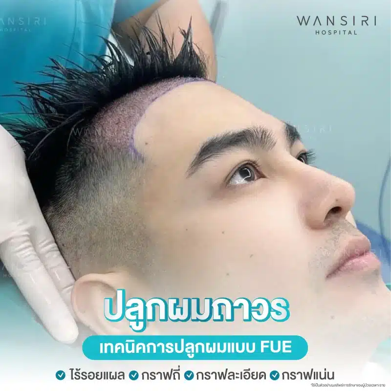 เทคนิคการปลูกผมแบบ FUE (Follicular Unit Extraction) ของทางโรงพยาบาลวรรณสิริ