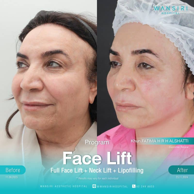 Reviews Face Lift Surgery