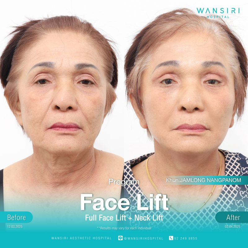 Reviews Face Lift Surgery