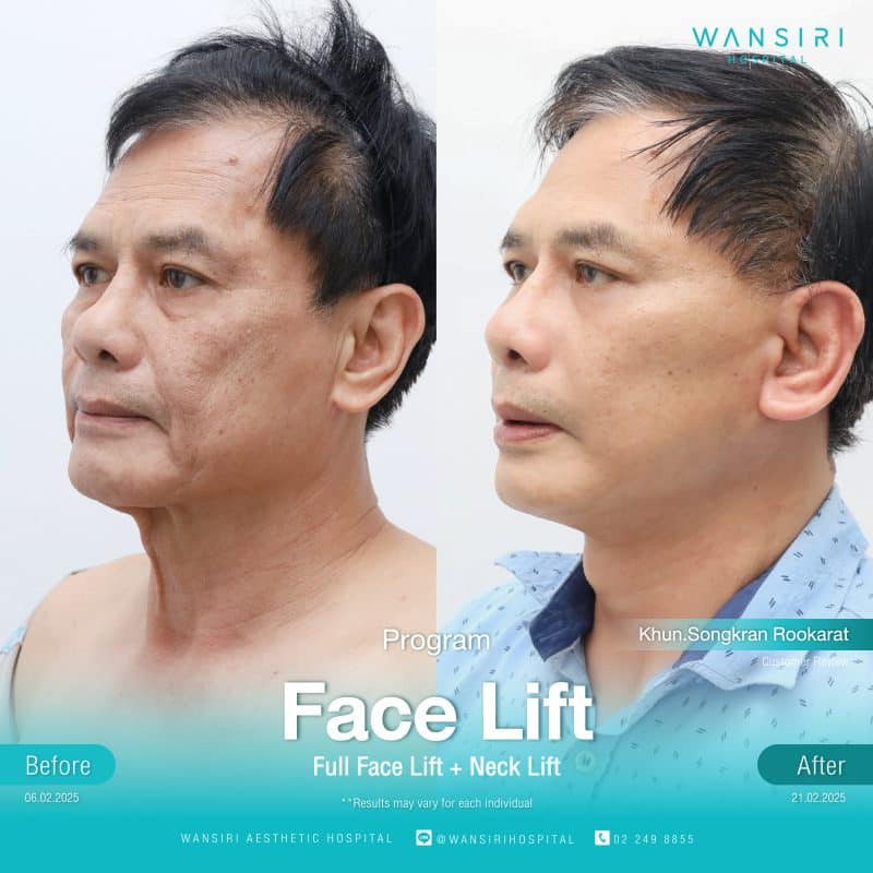Reviews Face Lift Surgery