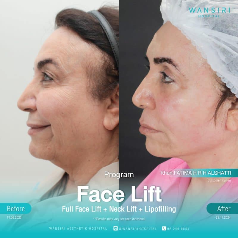 Reviews Face Lift Surgery