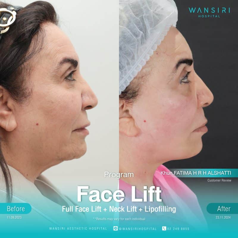 Reviews Face Lift Surgery
