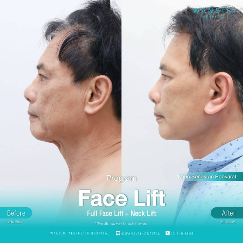 Reviews Face Lift Surgery