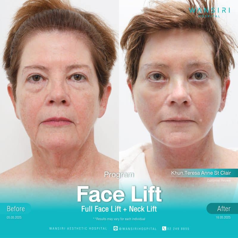 Reviews Face Lift Surgery