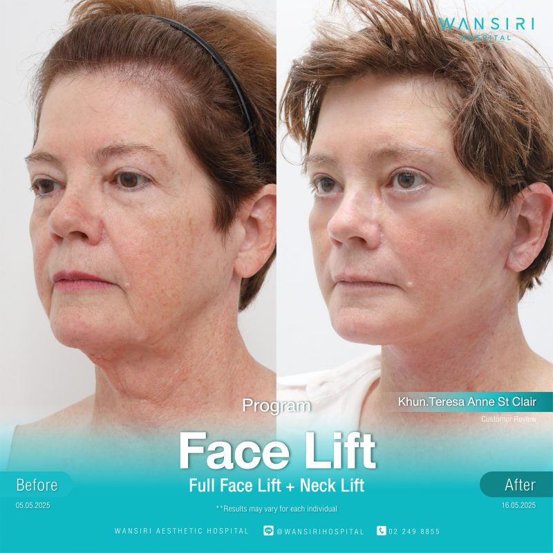 Reviews Face Lift Surgery