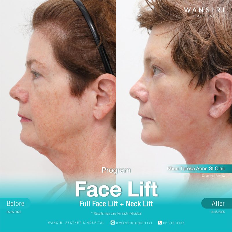 Reviews Face Lift Surgery