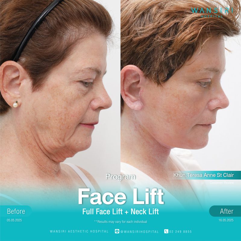 Reviews Face Lift Surgery