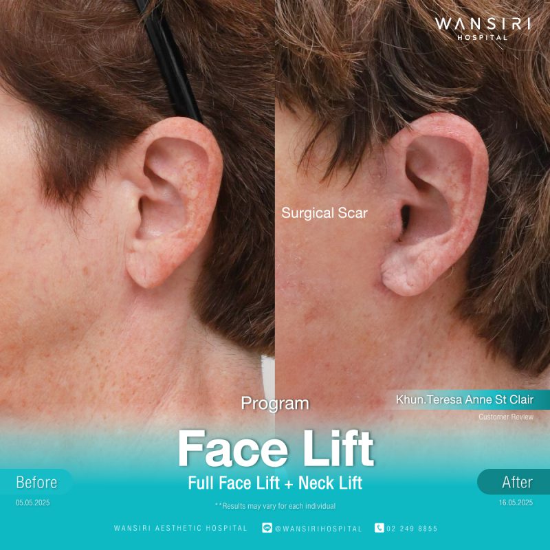 Reviews Face Lift Surgery