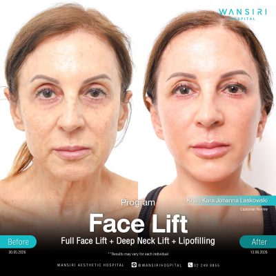 Deep Plane Facelift in Bangkok | Face Lift & Neck Lift | Wansiri Hospital
