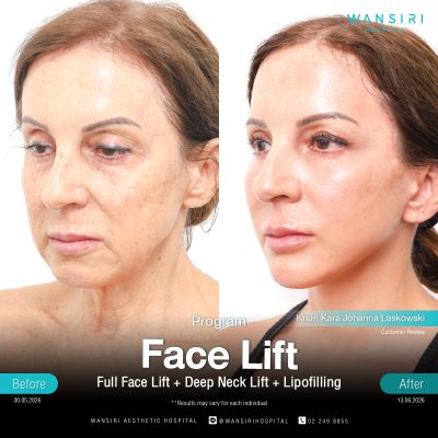 Deep Plane Facelift in Bangkok | Face Lift & Neck Lift | Wansiri Hospital