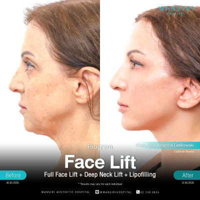 Deep Plane Facelift in Bangkok | Face Lift & Neck Lift | Wansiri Hospital