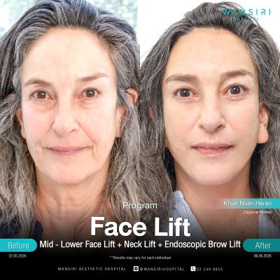 Deep Plane Facelift in Bangkok | Face Lift & Neck Lift | Wansiri Hospital