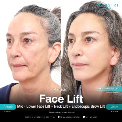 Deep Plane Facelift in Bangkok | Face Lift & Neck Lift | Wansiri Hospital