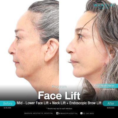 Deep Plane Facelift in Bangkok | Face Lift & Neck Lift | Wansiri Hospital