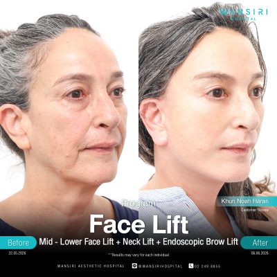 Deep Plane Facelift in Bangkok | Face Lift & Neck Lift | Wansiri Hospital