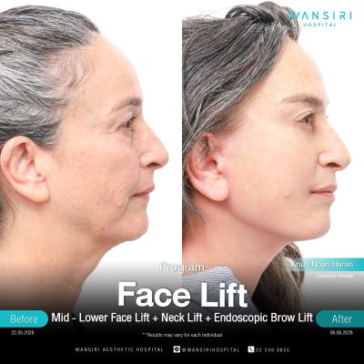 Deep Plane Facelift in Bangkok | Face Lift & Neck Lift | Wansiri Hospital