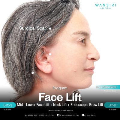 Deep Plane Facelift in Bangkok | Face Lift & Neck Lift | Wansiri Hospital