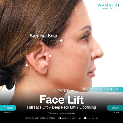 Deep Plane Facelift in Bangkok | Face Lift & Neck Lift | Wansiri Hospital