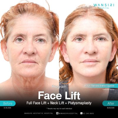 Deep Plane Facelift in Bangkok | Face Lift & Neck Lift | Wansiri Hospital