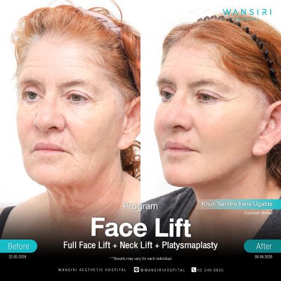 Deep Plane Facelift in Bangkok | Face Lift & Neck Lift | Wansiri Hospital