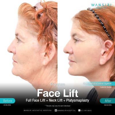 Deep Plane Facelift in Bangkok | Face Lift & Neck Lift | Wansiri Hospital