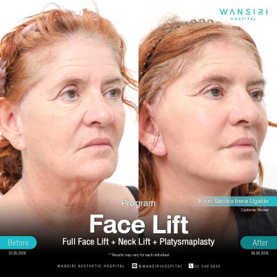 Deep Plane Facelift in Bangkok | Face Lift & Neck Lift | Wansiri Hospital