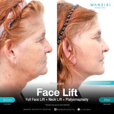 Deep Plane Facelift in Bangkok | Face Lift & Neck Lift | Wansiri Hospital