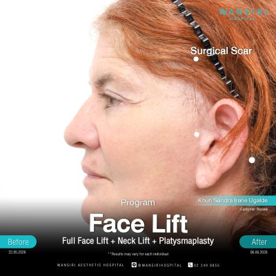 Deep Plane Facelift in Bangkok | Face Lift & Neck Lift | Wansiri Hospital