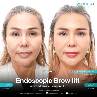 Endoscopic Brow Lift before and after results at Wansiri Hospital Bangkok