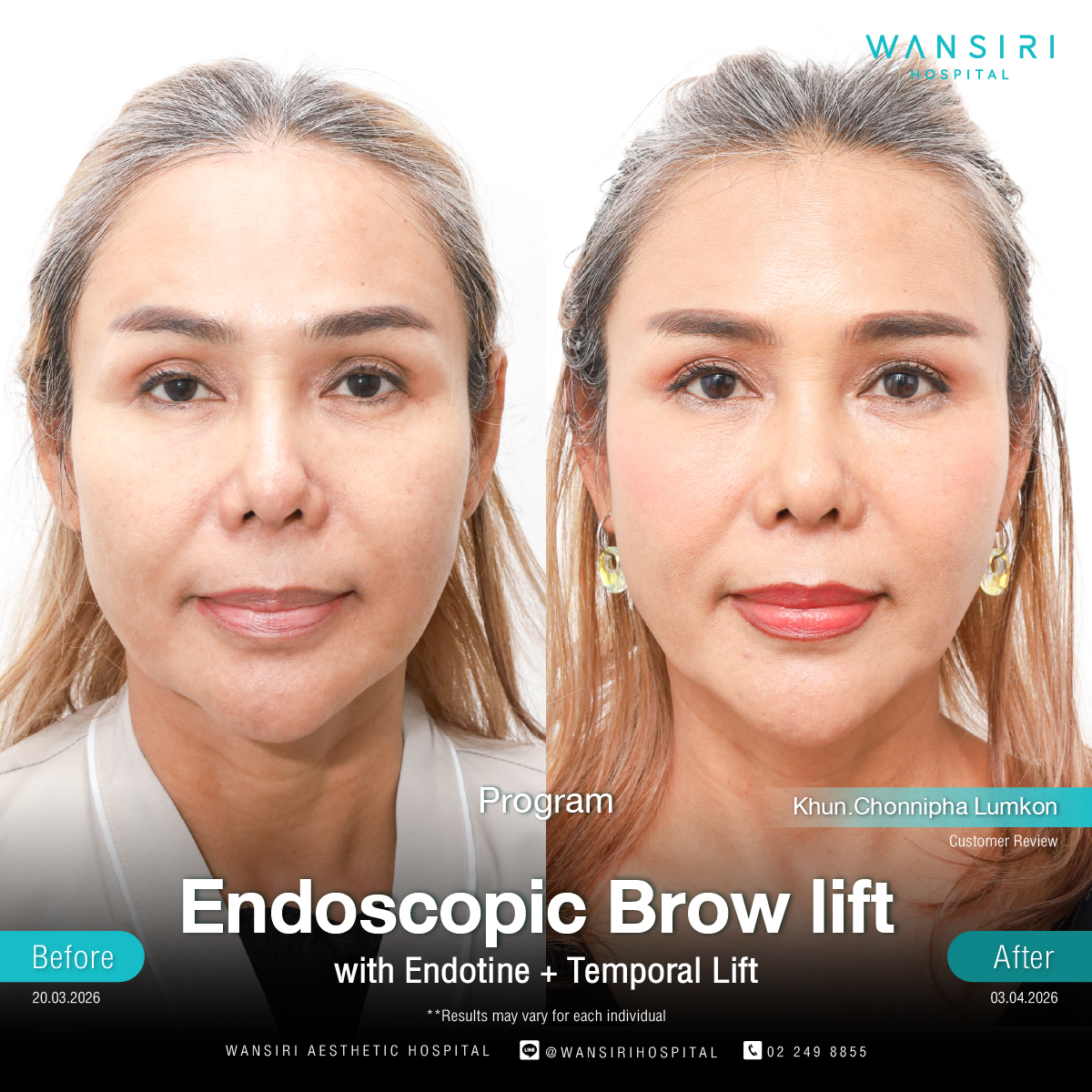 Endoscopic Brow Lift before and after results at Wansiri Hospital Bangkok