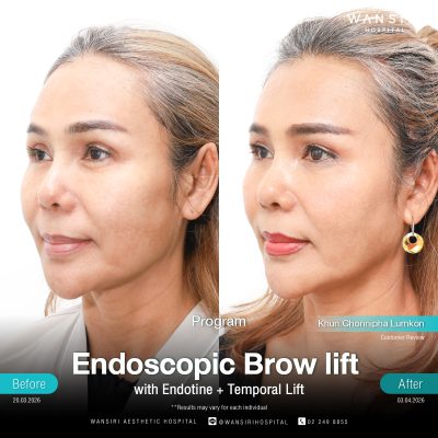 Endoscopic Brow Lift before and after results at Wansiri Hospital Bangkok