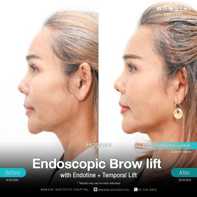 Endoscopic Brow Lift before and after results at Wansiri Hospital Bangkok