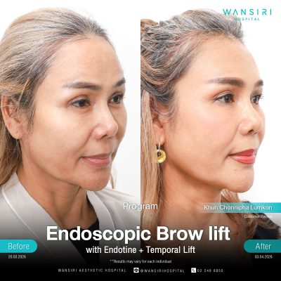 Endoscopic Brow Lift before and after results at Wansiri Hospital Bangkok