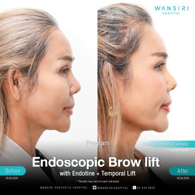 Endoscopic Brow Lift before and after results at Wansiri Hospital Bangkok