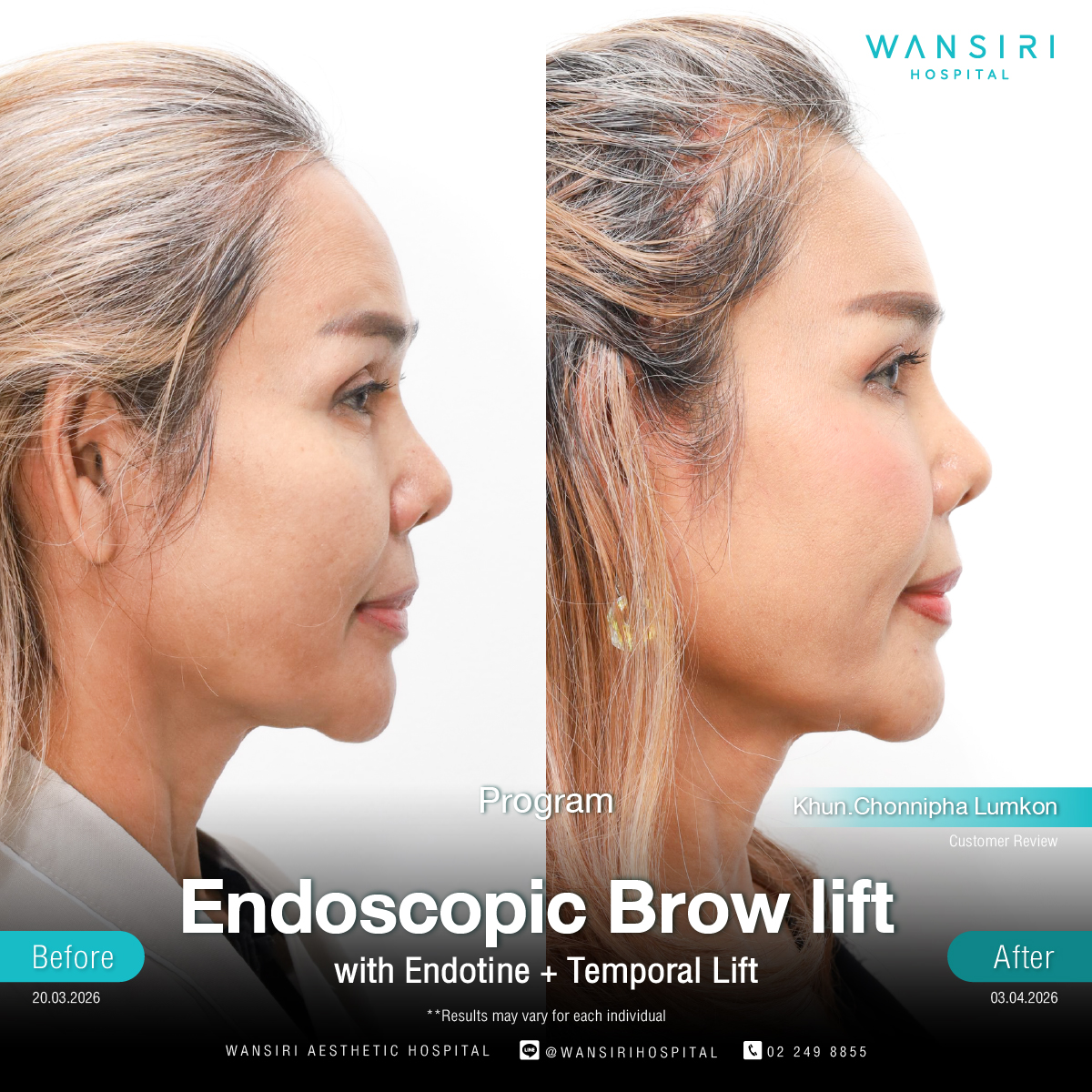 Endoscopic Brow Lift before and after results at Wansiri Hospital Bangkok