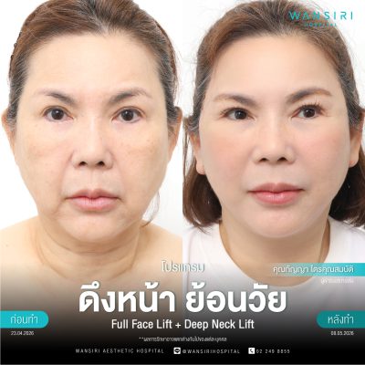 ดึงหน้า, ดึงหน้า ชั้นลึก, Face Lift, Deep Plane Facelift, Neck Lift