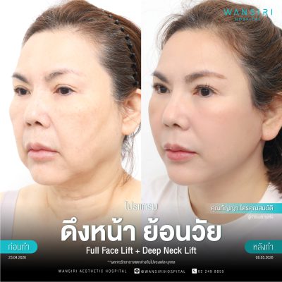 ดึงหน้า, ดึงหน้า ชั้นลึก, Face Lift, Deep Plane Facelift, Neck Lift