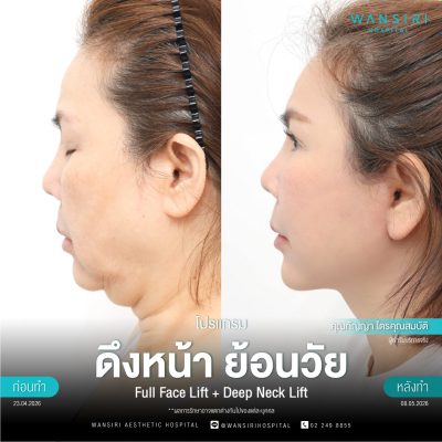 ดึงหน้า, ดึงหน้า ชั้นลึก, Face Lift, Deep Plane Facelift, Neck Lift