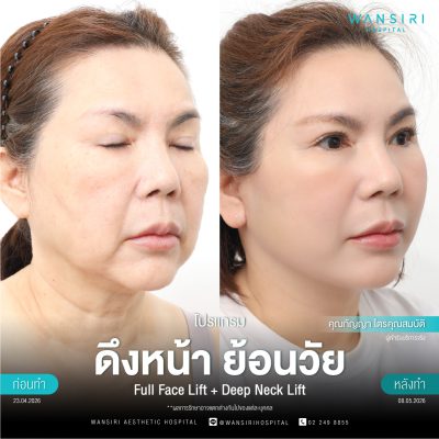 ดึงหน้า, ดึงหน้า ชั้นลึก, Face Lift, Deep Plane Facelift, Neck Lift