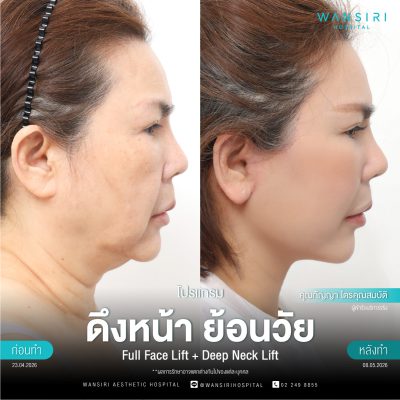 ดึงหน้า, ดึงหน้า ชั้นลึก, Face Lift, Deep Plane Facelift, Neck Lift