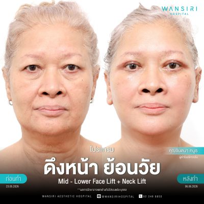 ดึงหน้า, ดึงหน้า ชั้นลึก, Face Lift, Deep Plane Facelift, Neck Lift