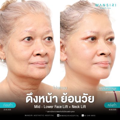 ดึงหน้า, ดึงหน้า ชั้นลึก, Face Lift, Deep Plane Facelift, Neck Lift